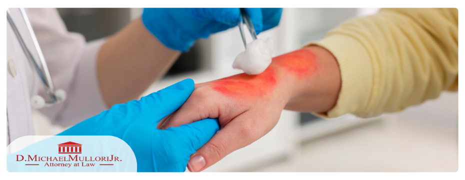 A close-up of a hand burn injury being taken care of a doctor in Woodbridge